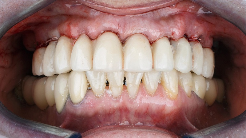 calcium deficiency pregnancy teeth
