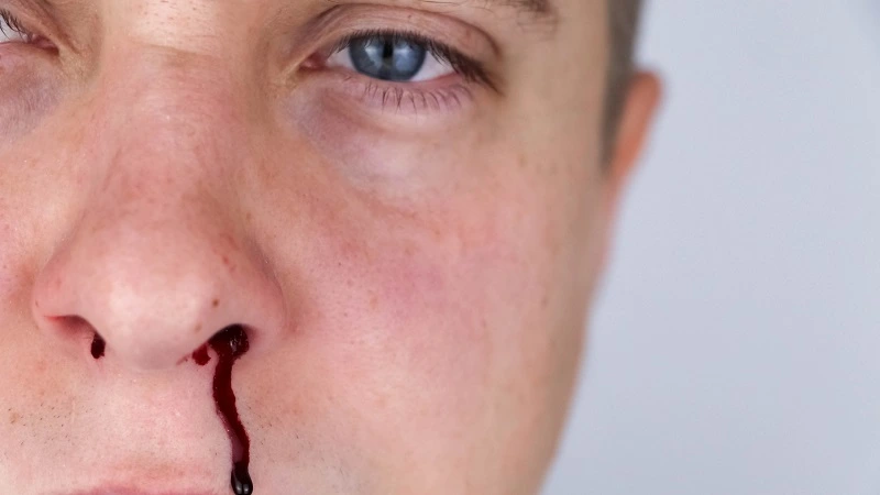 nose bleeding after hitting head