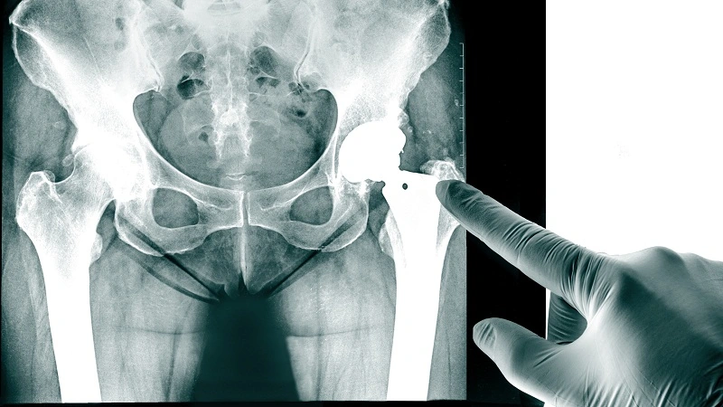 buttock pain after lumbar fusion