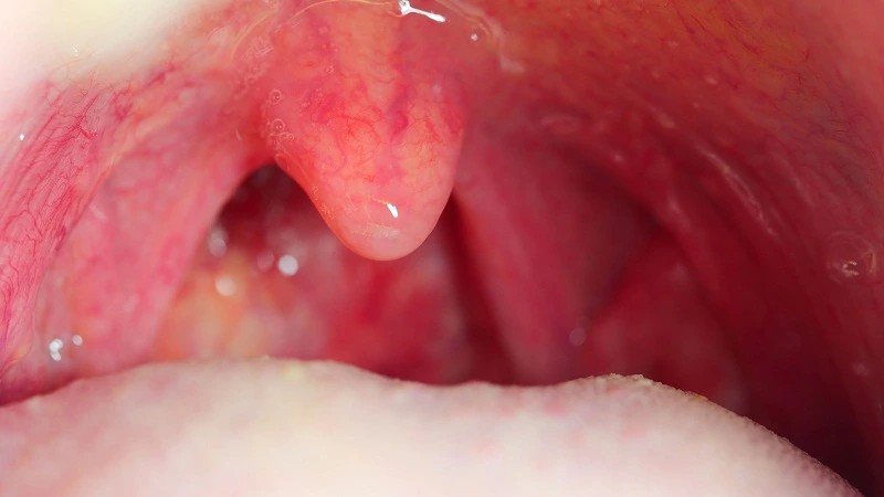 sore throat after wisdom teeth removal