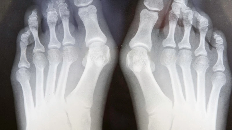 how long does it take for bunion splint to correct
