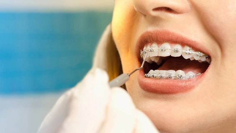 oral hygiene with braces