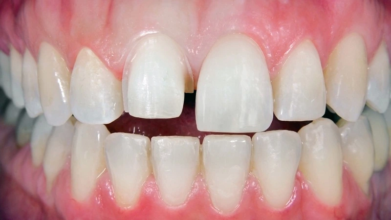 do you need braces before veneers