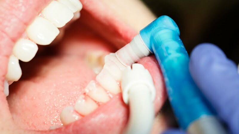 how long does a dental cleaning take?