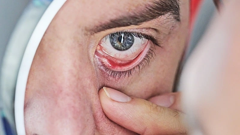 can astigmatism cause eye twitching?