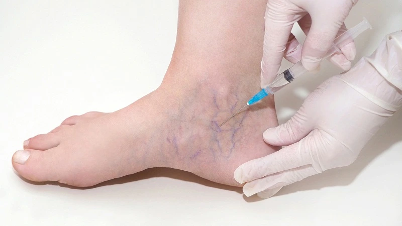 can varicose veins go away with weight loss?