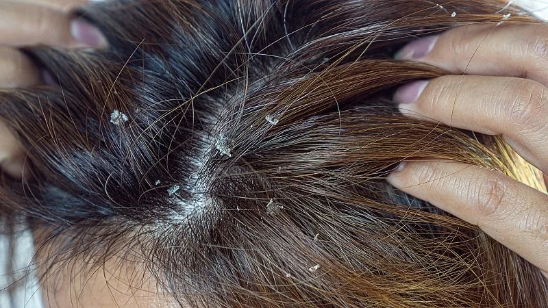 can blow drying hair cause dandruff