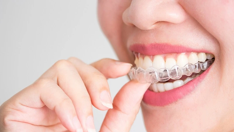 can open bite be fixed with invisalign