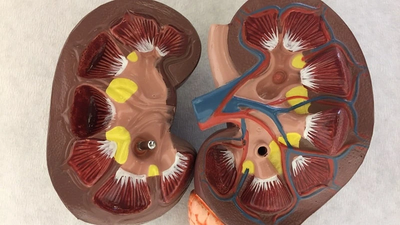 gout in kidney transplant patients