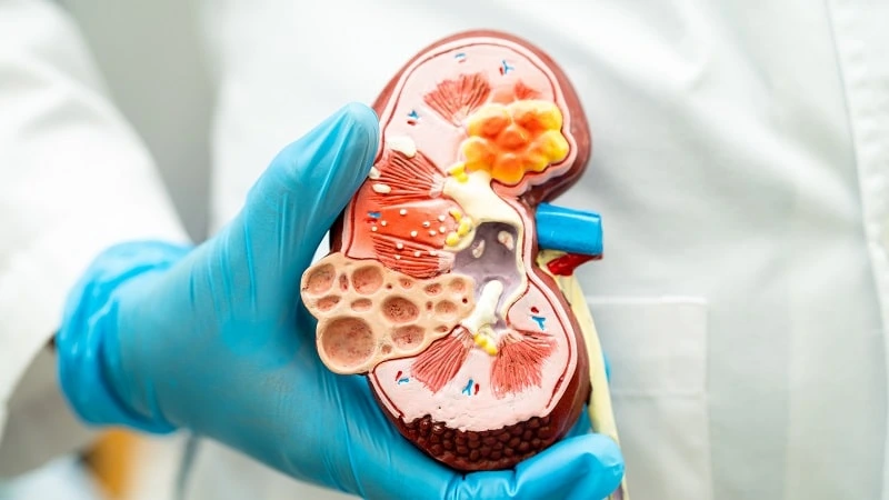 gout in kidney transplant patients