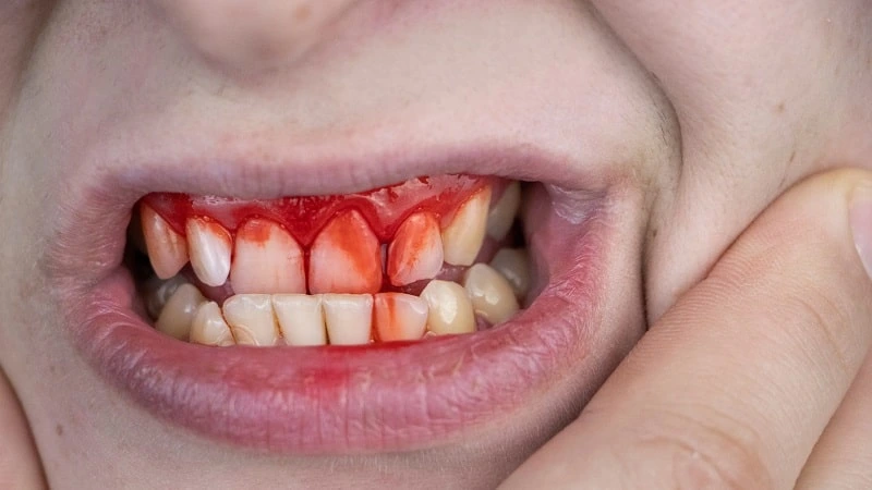 loose gum flap between teeth
