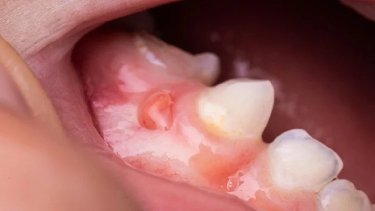 how to drain a gum abscess at home