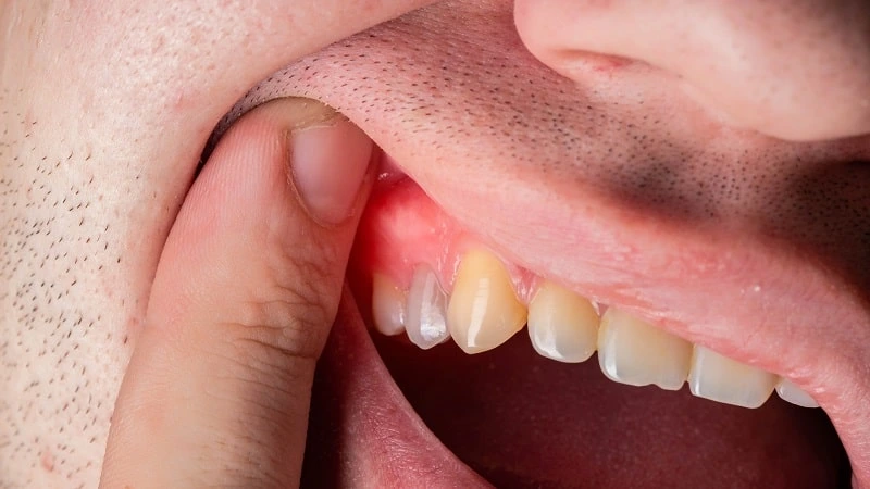 how to cure gum disease without a dentist