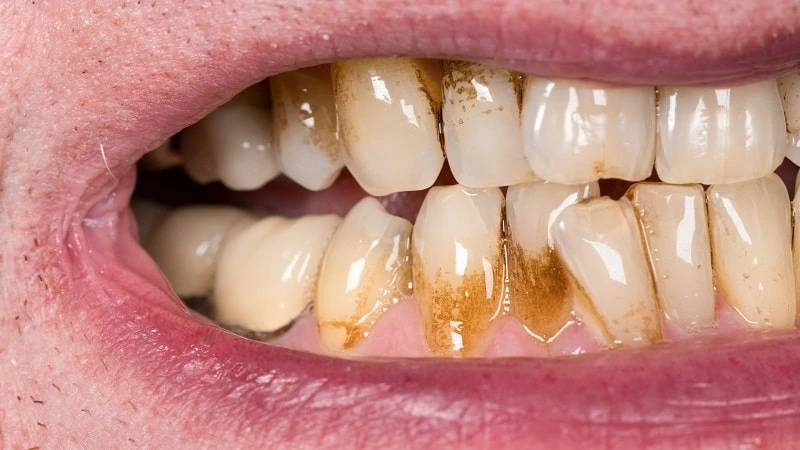 gingivitis white spots on gums