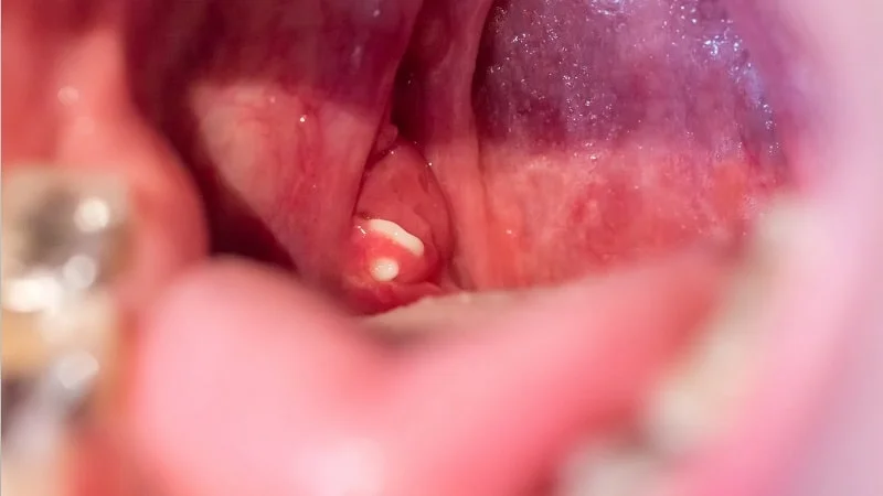 does vaping cause tonsil stones